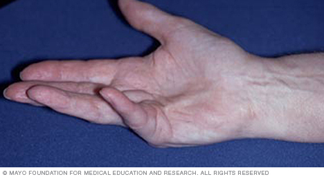 Dupuytren's contracture image Mayo Clinic